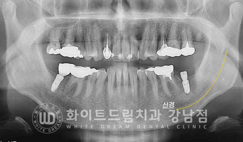 강남역 임플란트재수술 치과 / "임플란트가 흔들려요!" 임플란트 주위염 관련 이미지 9
