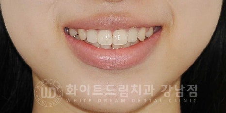 역삼역 왜소치치료 / 치아 하나가 너무 작아요. 왜소치 라미네이트 잘하는 치과 관련 이미지 12