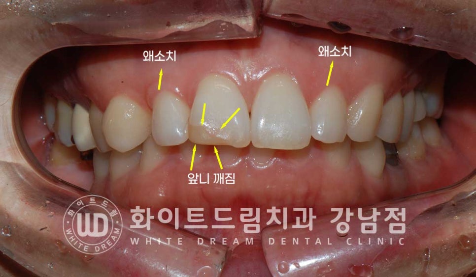 앞니 원데이라미네이트, 뻐드러지고 벌어진 앞니! 당일 치료 ok 관련 이미지 7
