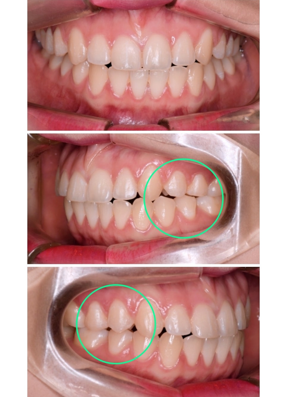 치아교정, 꼭 해야 한다면 미리 알아 두자. 관련 이미지 17
