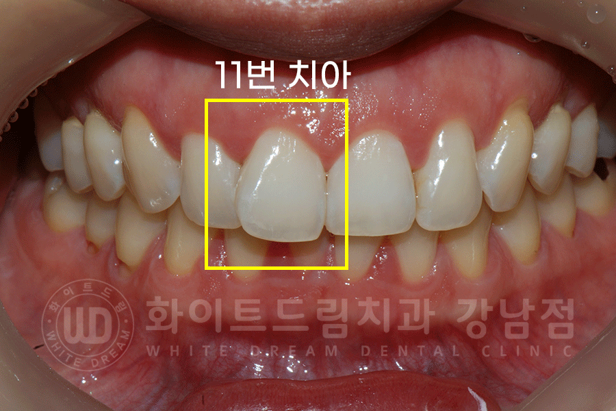 강남역 앞니라미네이트 "틀어진 토끼 앞니 빠르게 개선" 강남역 라미네이트 치과 관련 이미지 2