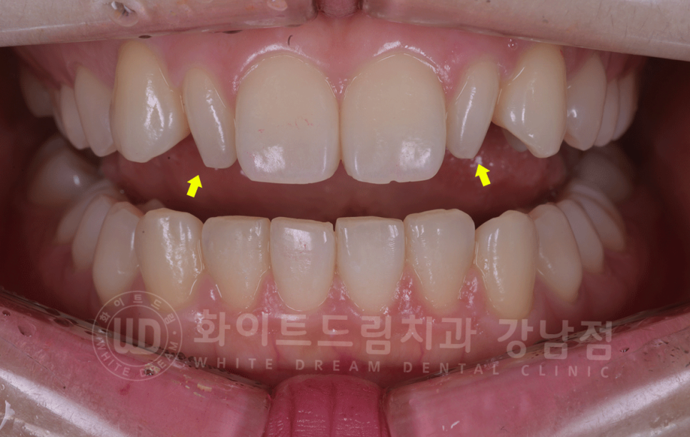 강남역 심미치과 "치아 하나가 유난히 작아요" #왜소치라미네이트 관련 이미지 2