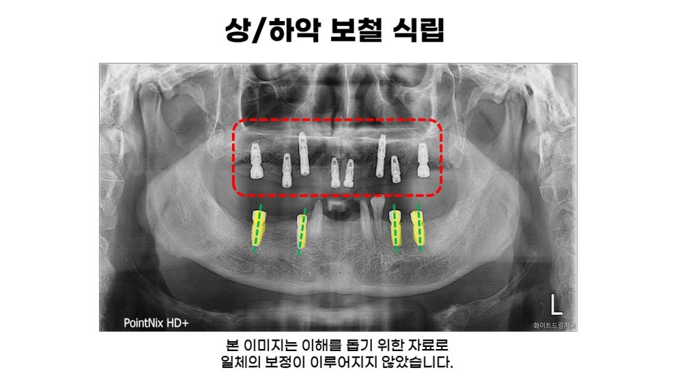 60대 전악임플란트후기 및 치료기간 관련 이미지 6