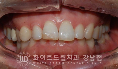 앞니 원데이라미네이트 / 떨어진 앞니 레진 & 벌어진 앞니, 라미네이트로 당일 개선 ★ 관련 이미지 10