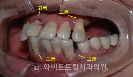 강남역전체임플란트 / 발치 후 즉시 식립, 무조건 누구나 3개월로 끝낼 수 있는 것일까? 강남역화이트드림치과 관련 이미지 6