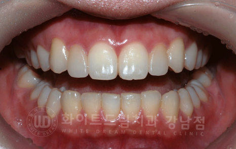 강남역 심미치과 "치아 하나가 유난히 작아요" #왜소치라미네이트 관련 이미지 9