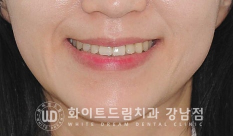 치경부착색 치료 / 라미네이트 vs 올세라믹 치아 삭제량 비교 (Feat. 라미네이트 후 치아미백 가능한가요?) 관련 이미지 10