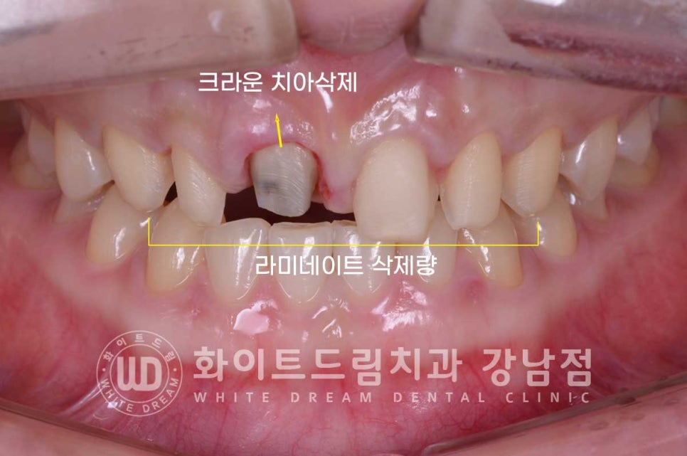 벌어진 앞니라미네이트 / "왜소치로 치아가 벌어졌어요" 치료 사례 관련 이미지 7