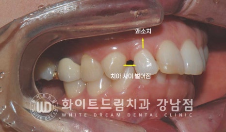 앞니 원데이라미네이트, 뻐드러지고 벌어진 앞니! 당일 치료 ok 관련 이미지 9