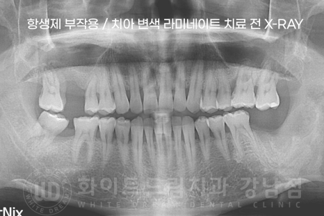 강남역 인근 치과 / 테트라사이클린(tetracycline) 치아 변색 / 라미네이트로 개선! 관련 이미지 13