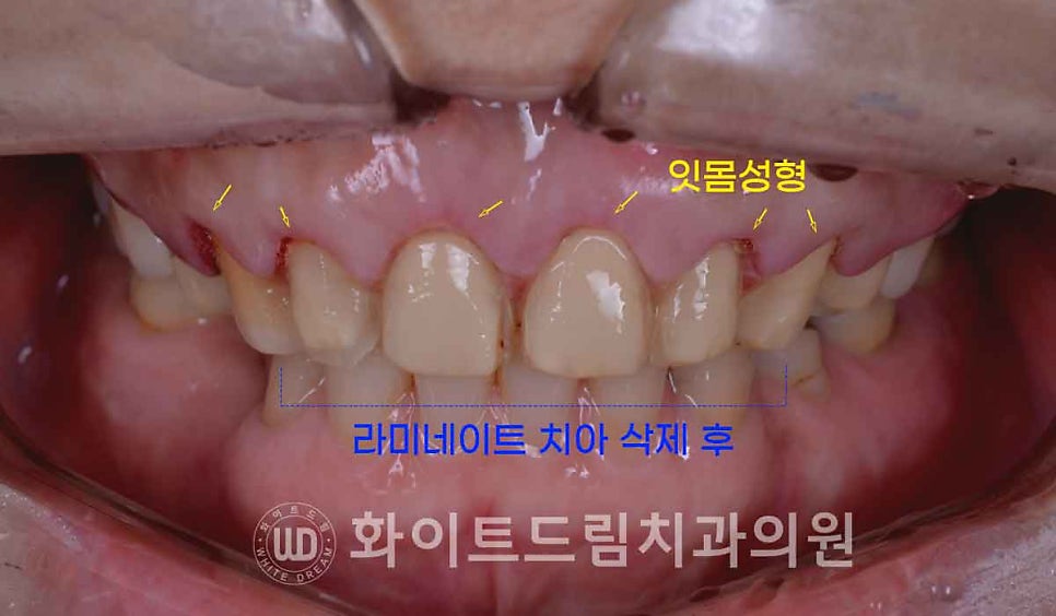 강남옹니라미네이트 "치아가 안으로 들어가서 할머니처럼 보여요" 경미 & 중증도 옹니 라미네이트 치료 관련 이미지 13