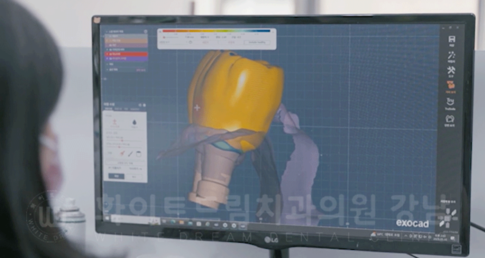 강남역 임플란트 치과 "틀니가 안 맞아서 불편해요" 틀니 → 전체 임플란트로! 관련 이미지 17