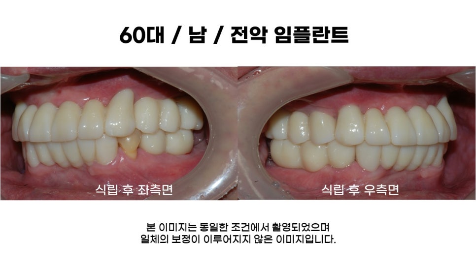 60대 전악임플란트후기 및 치료기간 관련 이미지 10