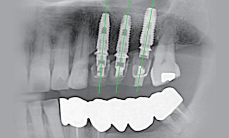 임플란트 하기 전 알아보아야 할 것. 관련 이미지 4