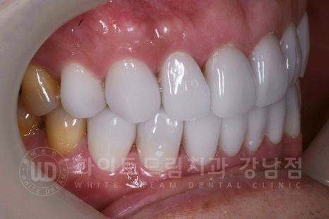강남역 인근 치과 / 테트라사이클린(tetracycline) 치아 변색 / 라미네이트로 개선! 관련 이미지 22