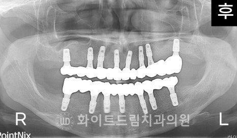 강남역전체임플란트 / 발치 후 즉시 식립, 무조건 누구나 3개월로 끝낼 수 있는 것일까? 강남역화이트드림치과 관련 이미지 17