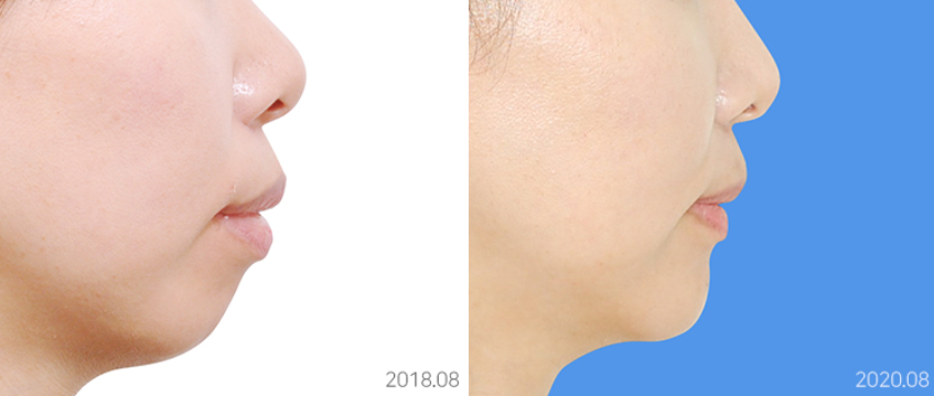 얼굴공개없는 치아교정 모델 모집 관련 이미지 10