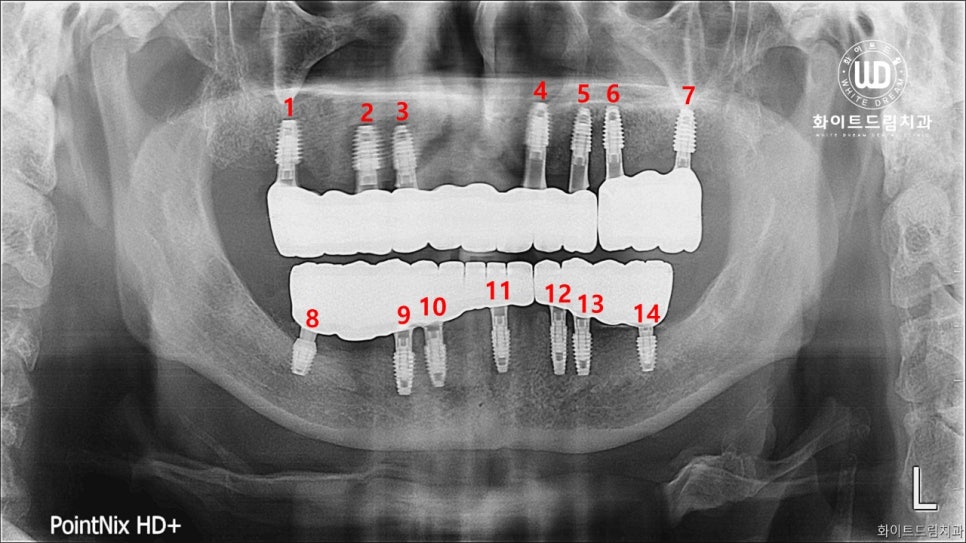 전체 치조골 이식을 동반한 고혈압 환자 임플란트 사례 관련 이미지 6
