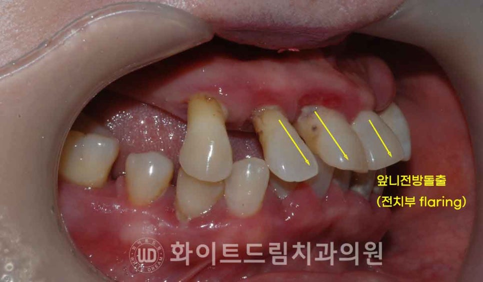 서울전체임플란트 / "경상도에서 왔어요." 치주염으로 인한 앞니 돌출 치료 (+서울전체임플란트 내원 횟수는?) 관련 이미지 9