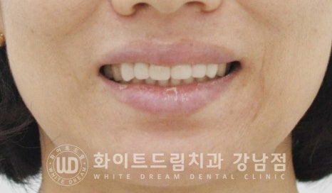 앞니 원데이라미네이트 / 떨어진 앞니 레진 & 벌어진 앞니, 라미네이트로 당일 개선 ★ 관련 이미지 9