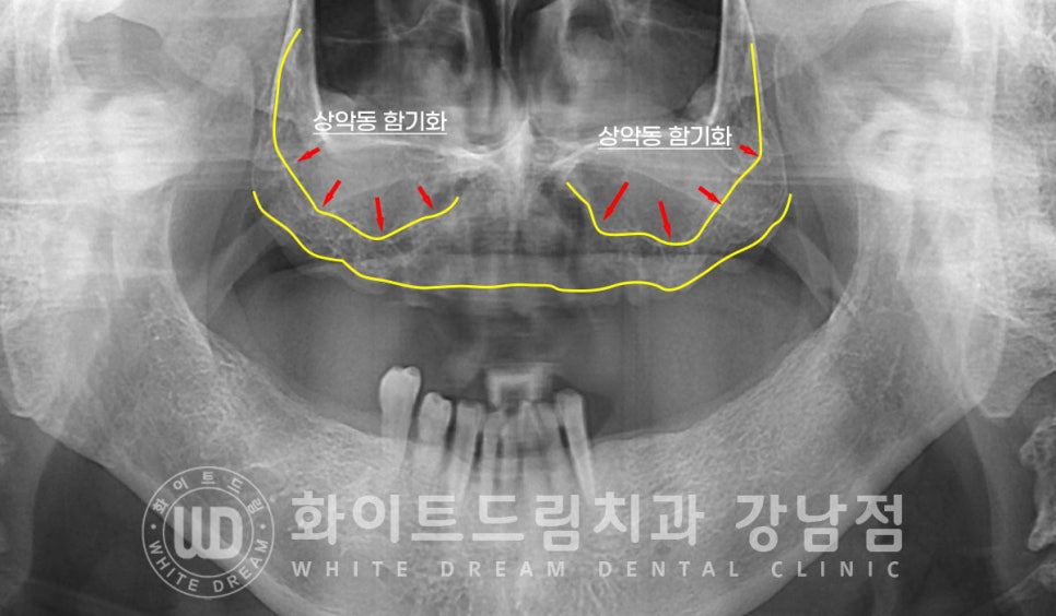 상악 풀케이스임플란트 사례 / "지인 추천으로 인천에서 왔어요." 관련 이미지 7