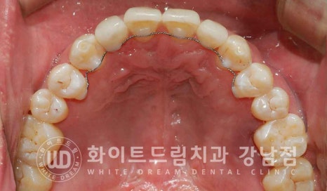 강남역 결손치 "앞니 두 개가 없고, 벌어졌어요" 결손치 치료 방법 관련 이미지 20