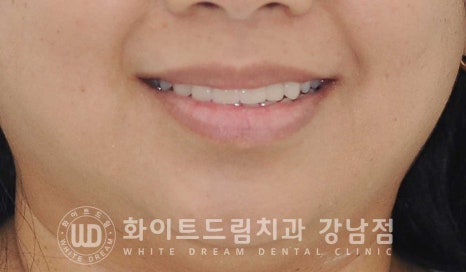 앞니 뻐드러짐 라미네이트 "뻐드러지고 벌어진 앞니" 당일 라미네이트 치료 case 관련 이미지 13