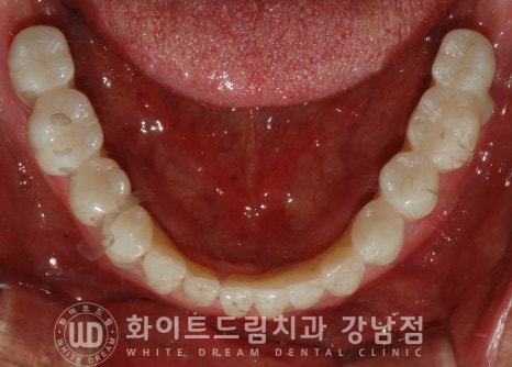 전체 임플란트 치료 기간과 수술 후 나타나는 변화는? 관련 이미지 17