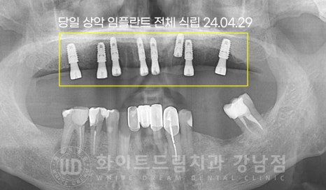전체 임플란트 치료 기간과 내원 횟수는? "치과에 자주 가기 어려워요." 관련 이미지 16