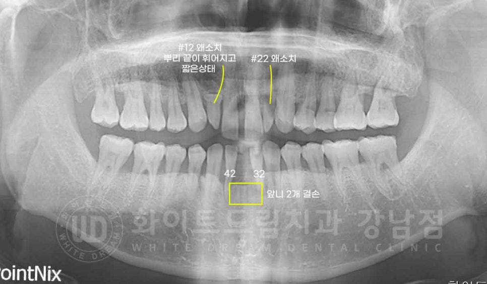 강남역 결손치 "앞니 두 개가 없고, 벌어졌어요" 결손치 치료 방법 관련 이미지 12