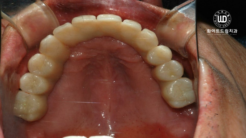전체 치조골 이식을 동반한 고혈압 환자 임플란트 사례 관련 이미지 9
