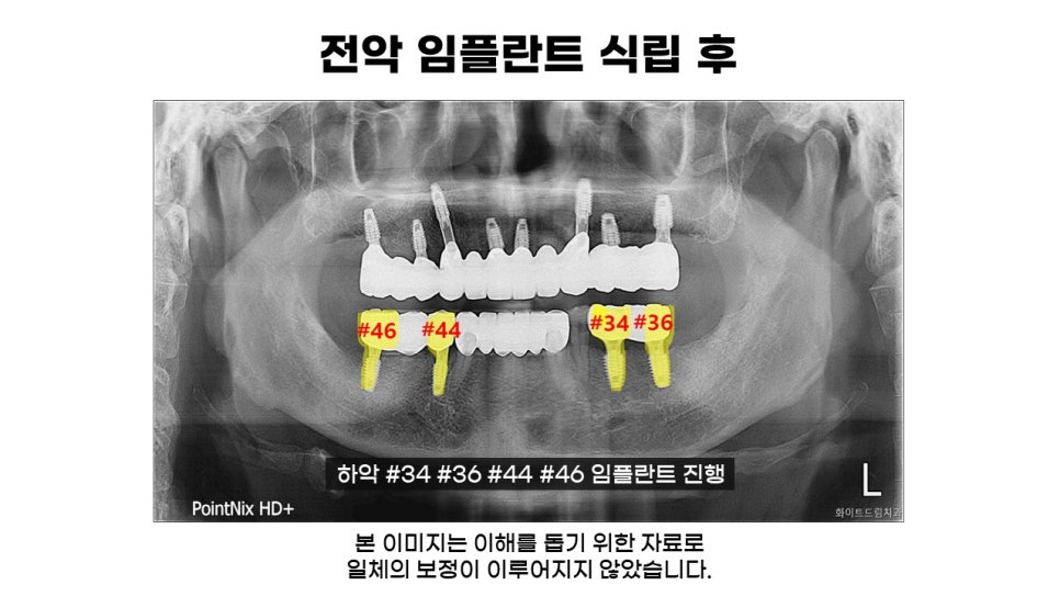 60대 전악임플란트후기 및 치료기간 관련 이미지 7