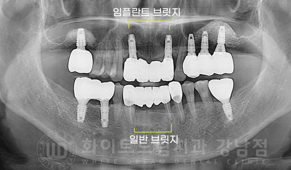 서초동 치과 추천 / "임플란트 개수를 줄이는 식립 방법은?" 강남 화이트드림치과 임플란트 관련 이미지 6