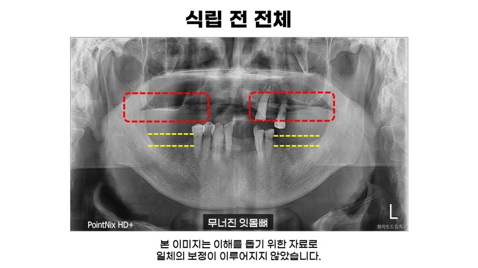 어금니임플란트 수복 및 당뇨환자임플란트 가격, 종류, 통증 관련 이미지 4