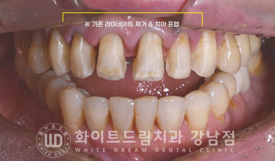 앞니라미네이트 교체 "5년 전에 한 라미네이트가 뻗쳐 보여요" 예쁘게 치료할 수 있나요? 관련 이미지 7