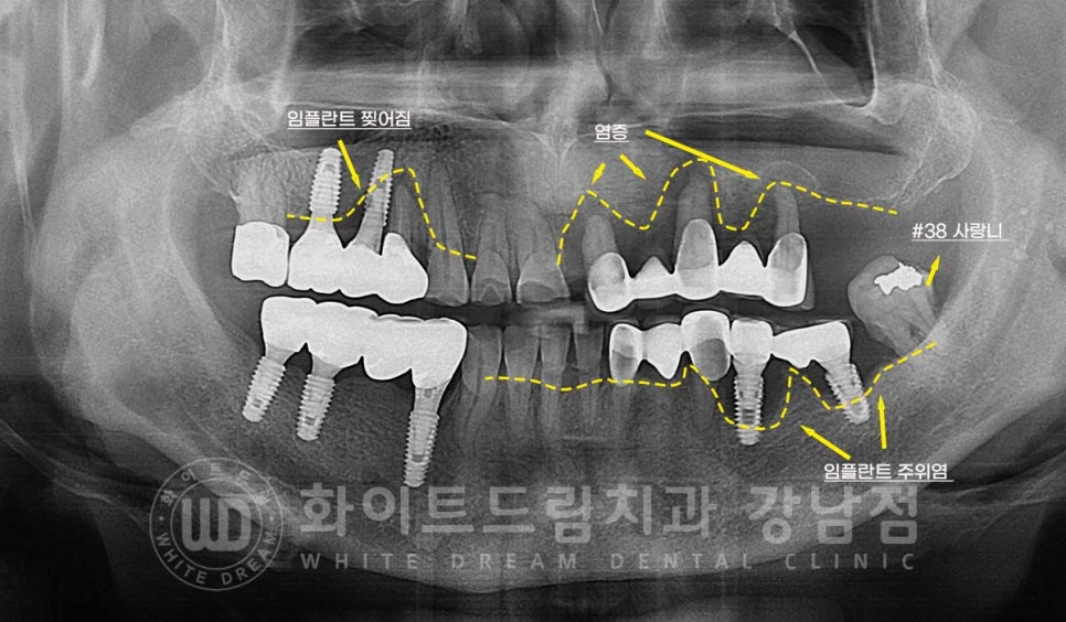 임플란트 재수술의 주원인, "임플란트 주위염과 임플란트 찢어짐!" 관련 이미지 2