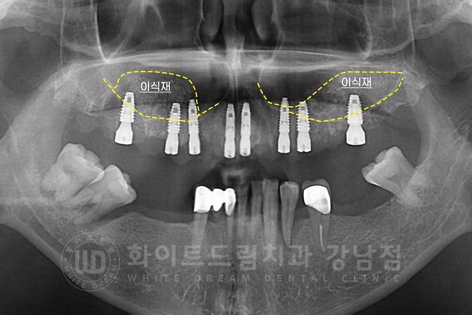 상악동거상술 잘하는치과, 강남역 화이트드림치과 상악동 함기화로 인한 거상술 치료 리뷰 관련 이미지 9