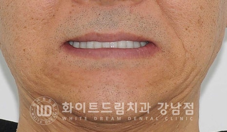 강남역 전악임플란트치과 / 치주 질환이 치아와 임플란트에 끼치는 영향! 관련 이미지 2