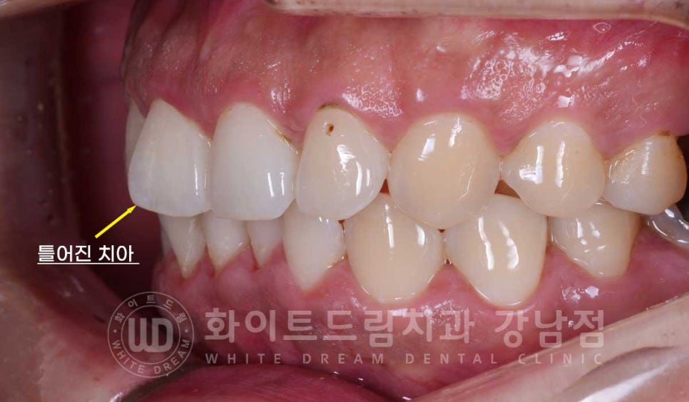 틀어진 치아 라미네이트, 틀어지고 색이 다른 앞니가 고민이에요. 관련 이미지 8