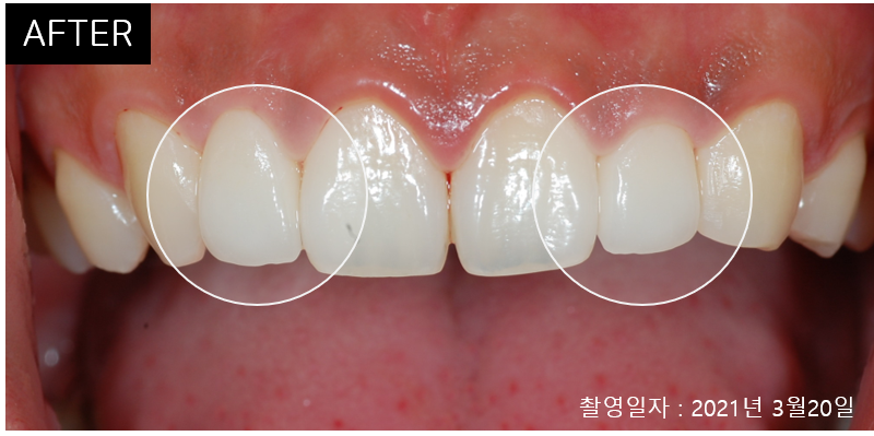 라미네이트 치료에 대해 알아보면? 관련 이미지 14