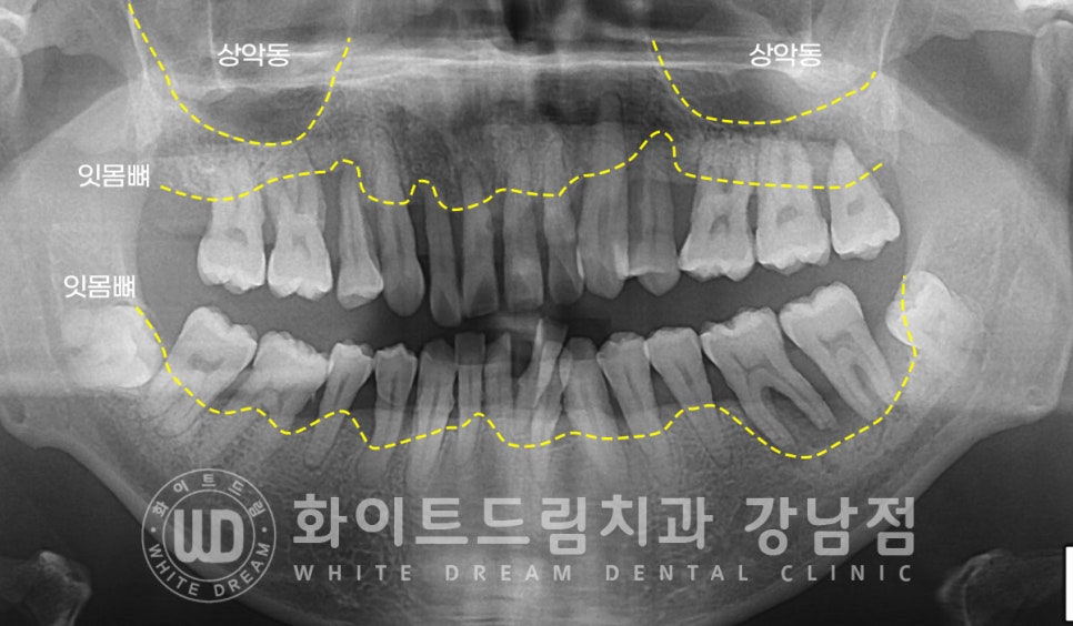 40대 전체임플란트 / 디지털스캔바디를 이용한 전체 임플란트 치료 사례 (Feat. 치주염) 관련 이미지 8