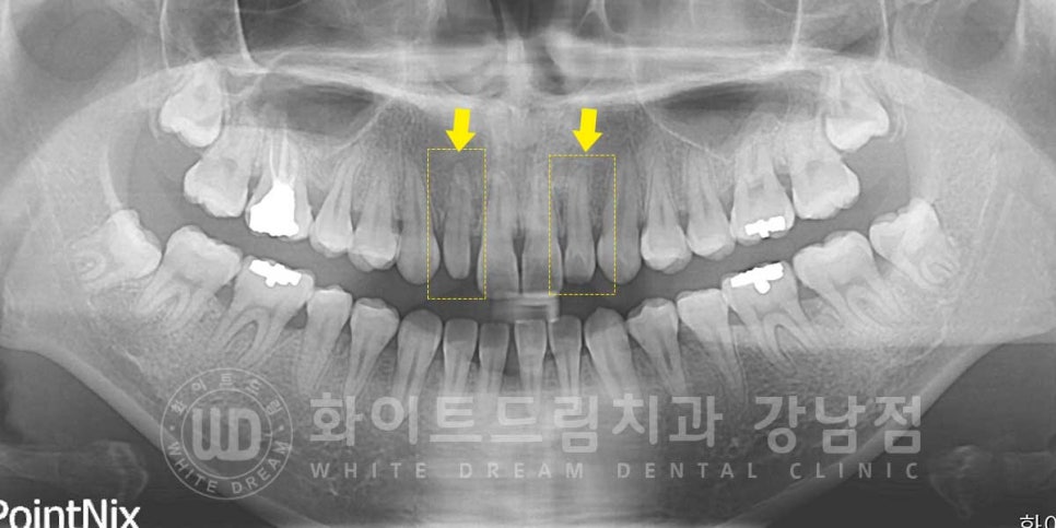 역삼역 왜소치치료 / 치아 하나가 너무 작아요. 왜소치 라미네이트 잘하는 치과 관련 이미지 6