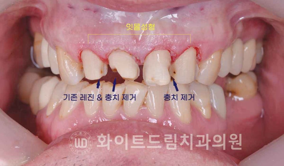신논현역 당일 라미네이트, "길이가 다른 깨진 앞니" 당일 앞니 라미네이트 치료 과정은? 관련 이미지 9