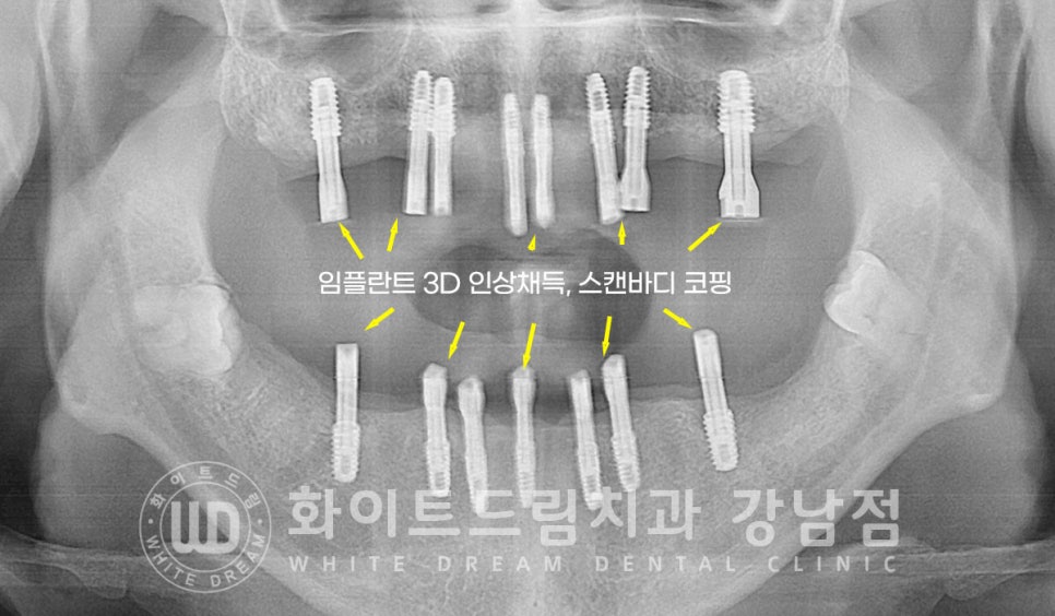 40대 전체임플란트 / 디지털스캔바디를 이용한 전체 임플란트 치료 사례 (Feat. 치주염) 관련 이미지 18