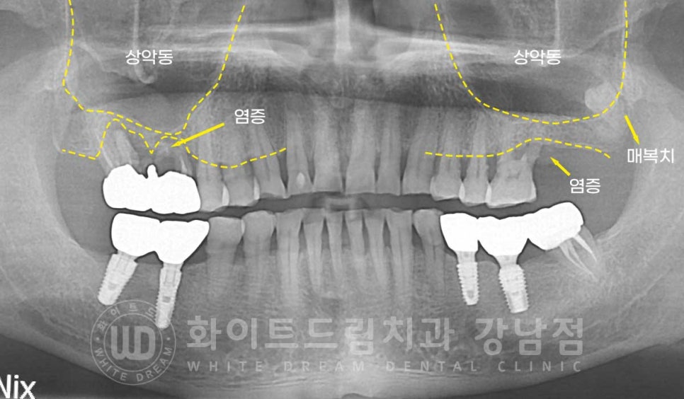 [흔들리는 어금니크라운] 흔들리고 냄새나는 오래된 크라운, 원인은? 관련 이미지 5