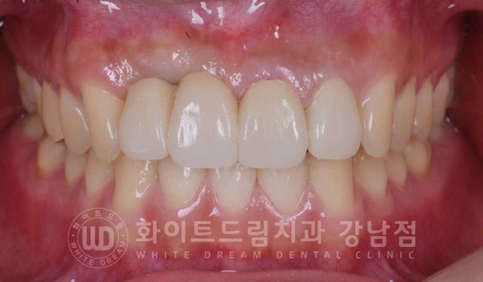 앞니 임플란트 사례 "예전에 심은 임플란트를 뺐어요. 재수술 가능할까요?" 관련 이미지 13