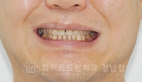 벌어지고 깨진 앞니, 웨딩 앞니 라미네이트 치료 사례 "남자도 자연스럽게 라미네이트 가능한가요?" 관련 이미지 2