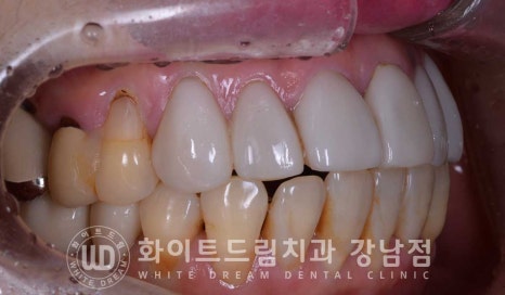 앞니라미네이트 교체 "5년 전에 한 라미네이트가 뻗쳐 보여요" 예쁘게 치료할 수 있나요? 관련 이미지 4