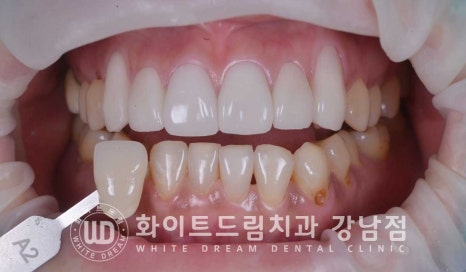 치경부착색 치료 / 라미네이트 vs 올세라믹 치아 삭제량 비교 (Feat. 라미네이트 후 치아미백 가능한가요?) 관련 이미지 16