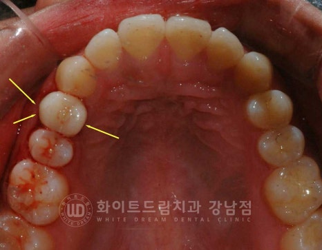 영구치 결손, "유치가 흔들려요." 성인 잔존 유치 발치 후 바로 임플란트 식립! 관련 이미지 11